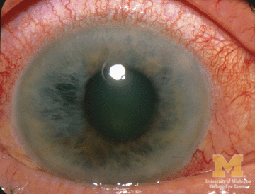 Image of eye with Acute Angle-Closure Glaucoma