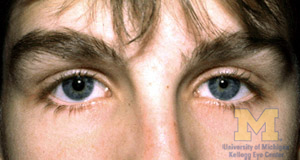 Image of eye with anisocoria
