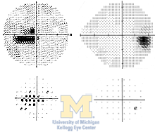 Cecocentral scotoma