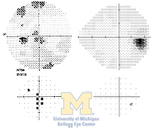 Central scotoma
