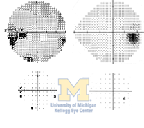 Temporal wedge scotoma