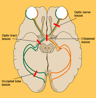 The Visual Pathway Lesions
